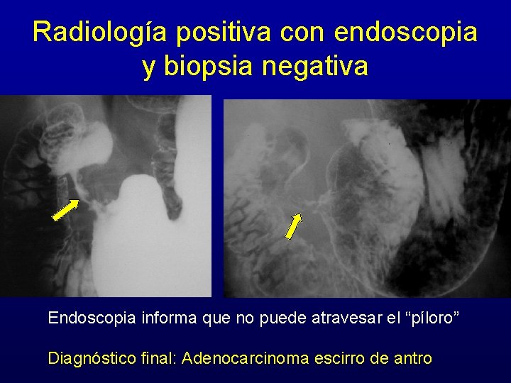 Radiología positiva con endoscopia y biopsia negativa Endoscopia informa que no puede atravesar el