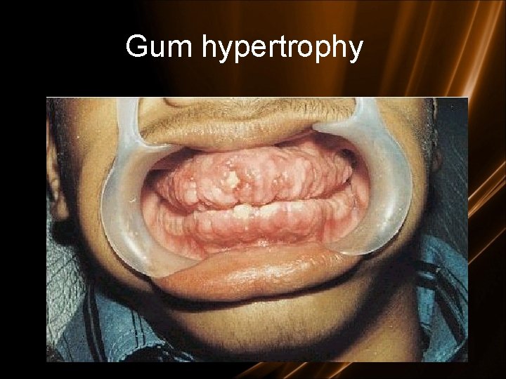 Gum hypertrophy Gum hypertrophy