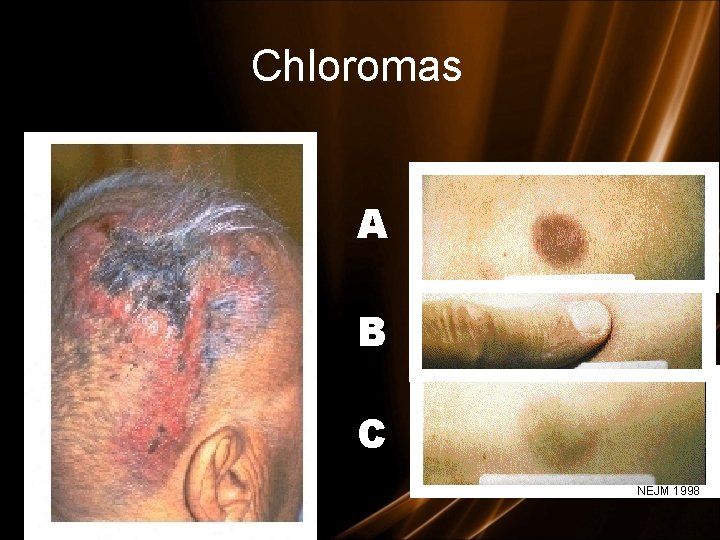 Chloromas A B C NEJM 1998 