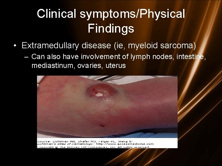 Clinical symptoms/Physical Findings • Extramedullary disease (ie, myeloid sarcoma) – Can also have involvement Clinical symptoms/Physical Findings • Extramedullary disease (ie, myeloid sarcoma) – Can also have involvement