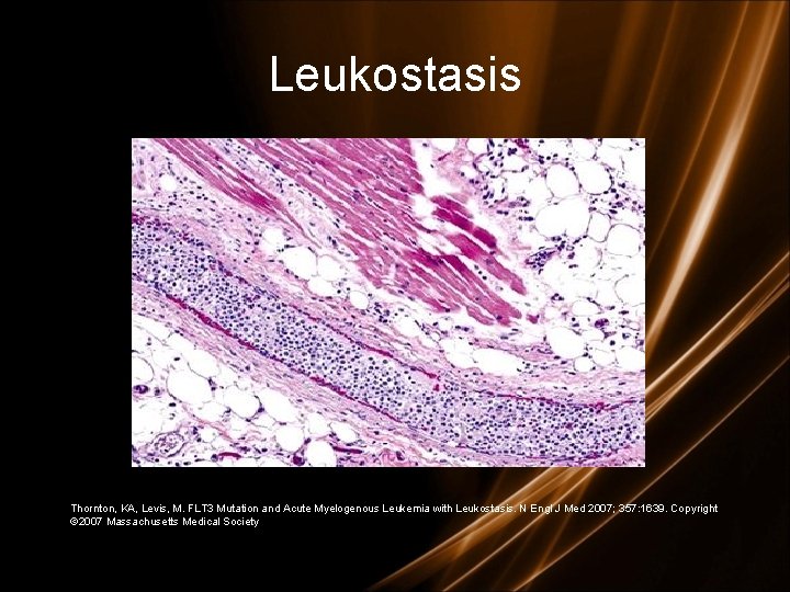 Leukostasis Thornton, KA, Levis, M. FLT 3 Mutation and Acute Myelogenous Leukemia with Leukostasis. Leukostasis Thornton, KA, Levis, M. FLT 3 Mutation and Acute Myelogenous Leukemia with Leukostasis.