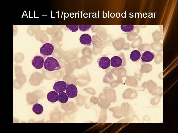 ALL – L 1/periferal blood smear 