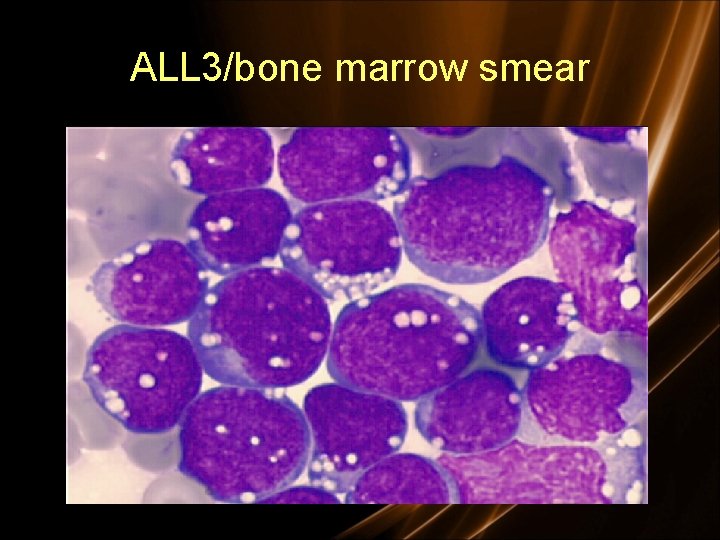 ALL 3/bone marrow smear 