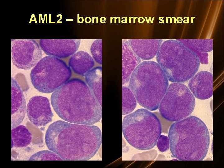 AML 2 – bone marrow smear 