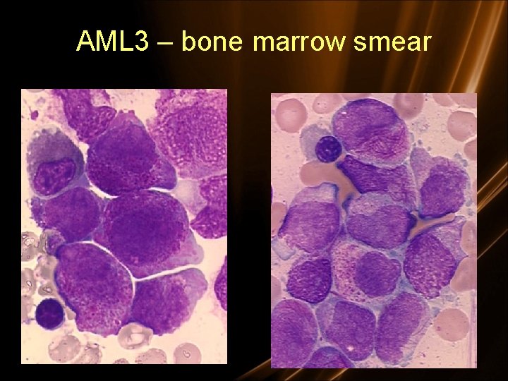 AML 3 – bone marrow smear 