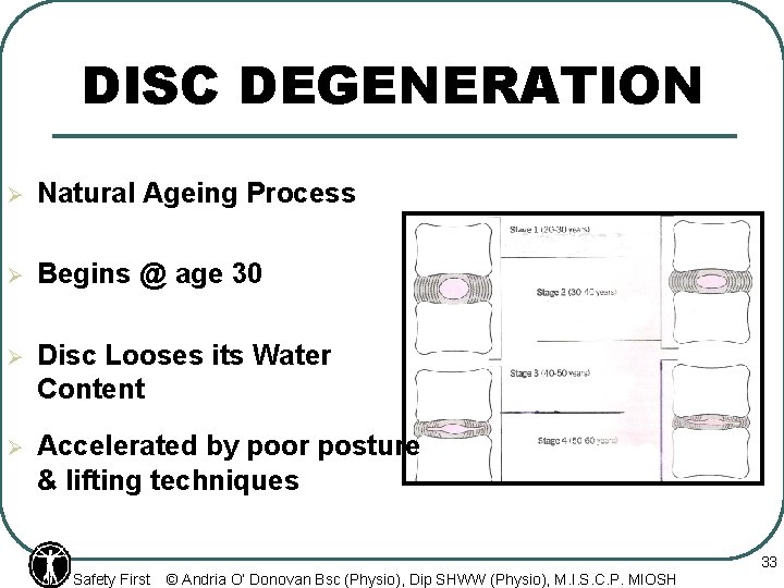DISC DEGENERATION Ø Natural Ageing Process Ø Begins @ age 30 Ø Disc Looses