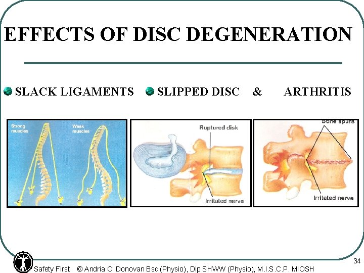 EFFECTS OF DISC DEGENERATION SLACK LIGAMENTS Safety First SLIPPED DISC & ARTHRITIS © Andria