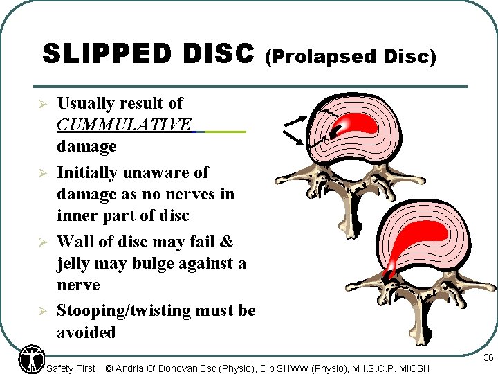 SLIPPED DISC Ø Ø Usually result of CUMMULATIVE damage Initially unaware of damage as