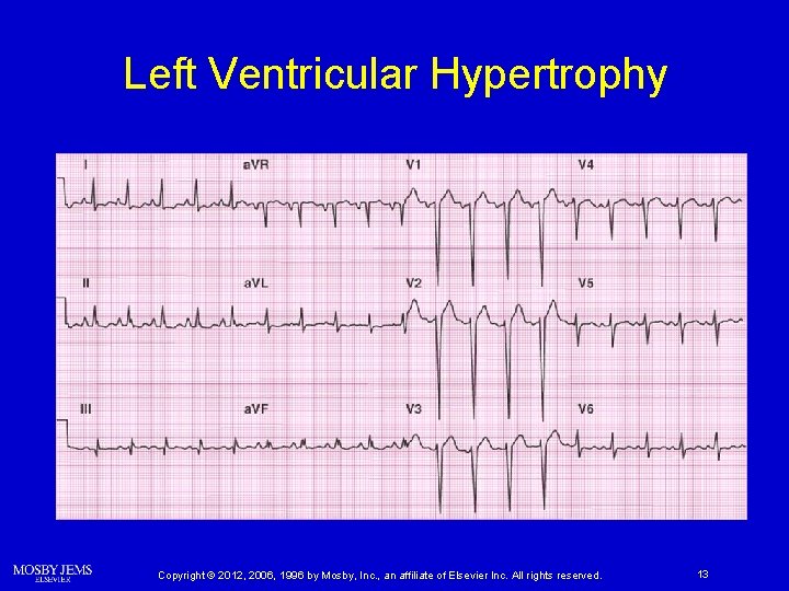 Left Ventricular Hypertrophy Copyright © 2012, 2006, 1996 by Mosby, Inc. , an affiliate