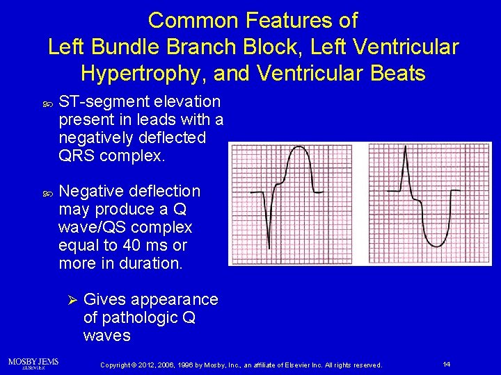 Common Features of Left Bundle Branch Block, Left Ventricular Hypertrophy, and Ventricular Beats ST-segment