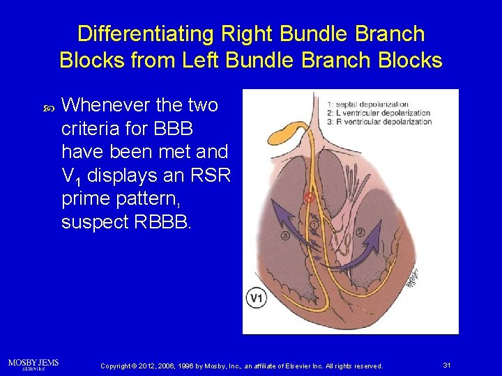 Differentiating Right Bundle Branch Blocks from Left Bundle Branch Blocks Whenever the two criteria