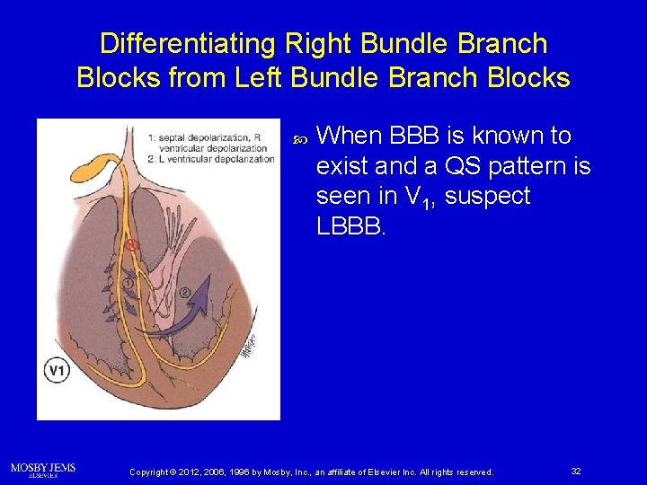 Differentiating Right Bundle Branch Blocks from Left Bundle Branch Blocks When BBB is known