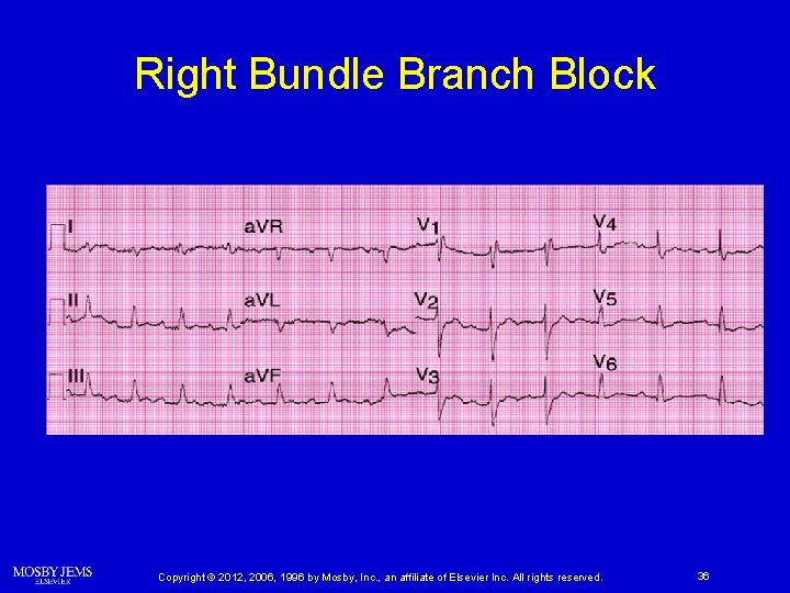 Right Bundle Branch Block Copyright © 2012, 2006, 1996 by Mosby, Inc. , an