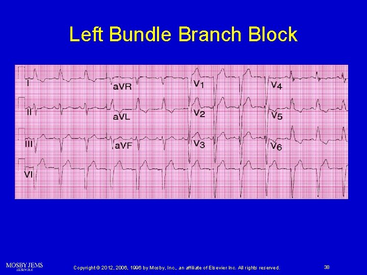 Left Bundle Branch Block Copyright © 2012, 2006, 1996 by Mosby, Inc. , an