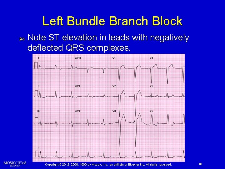 Left Bundle Branch Block Note ST elevation in leads with negatively deflected QRS complexes.