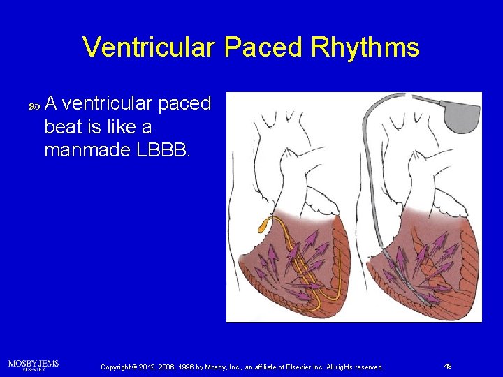 Ventricular Paced Rhythms A ventricular paced beat is like a manmade LBBB. Copyright ©
