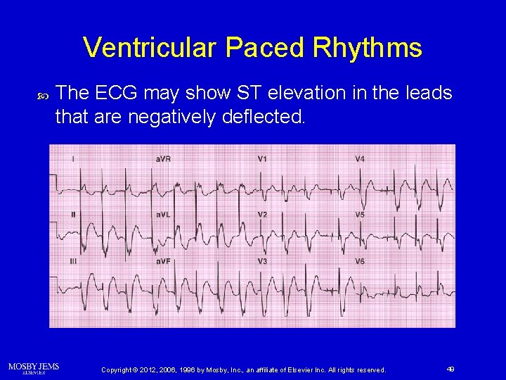 Ventricular Paced Rhythms The ECG may show ST elevation in the leads that are