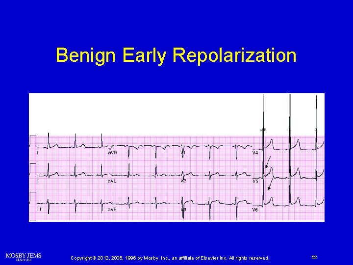 Benign Early Repolarization Copyright © 2012, 2006, 1996 by Mosby, Inc. , an affiliate