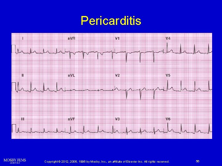 Pericarditis Copyright © 2012, 2006, 1996 by Mosby, Inc. , an affiliate of Elsevier