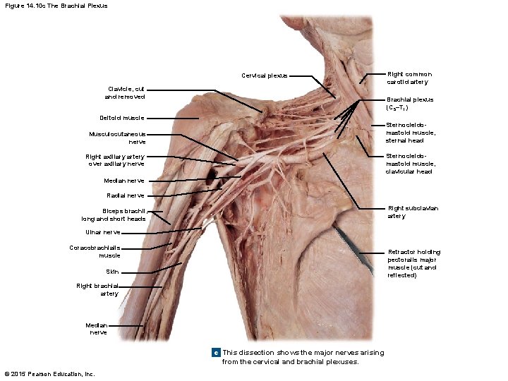 Figure 14. 10 c The Brachial Plexus Cervical plexus Clavicle, cut and removed Right