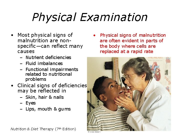Physical Examination • Most physical signs of malnutrition are nonspecific—can reflect many causes –