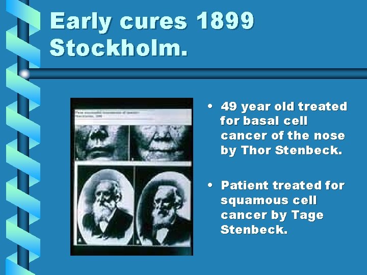 Early cures 1899 Stockholm. • 49 year old treated for basal cell cancer of Early cures 1899 Stockholm. • 49 year old treated for basal cell cancer of