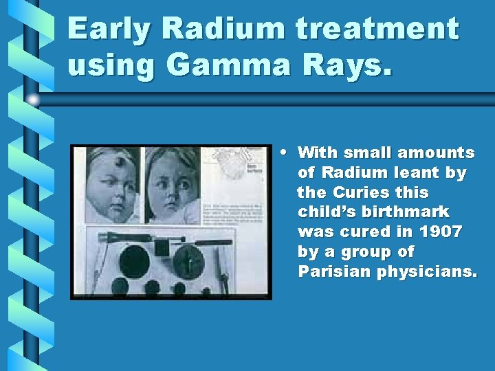 Early Radium treatment using Gamma Rays. • With small amounts of Radium leant by Early Radium treatment using Gamma Rays. • With small amounts of Radium leant by
