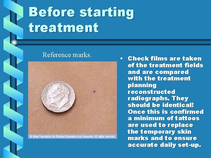 Before starting treatment Reference marks. • Check films are taken of the treatment fields Before starting treatment Reference marks. • Check films are taken of the treatment fields