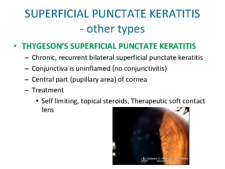 SUPERFICIAL PUNCTATE KERATITIS - other types • THYGESON’S SUPERFICIAL PUNCTATE KERATITIS – – Chronic, SUPERFICIAL PUNCTATE KERATITIS - other types • THYGESON’S SUPERFICIAL PUNCTATE KERATITIS – – Chronic,