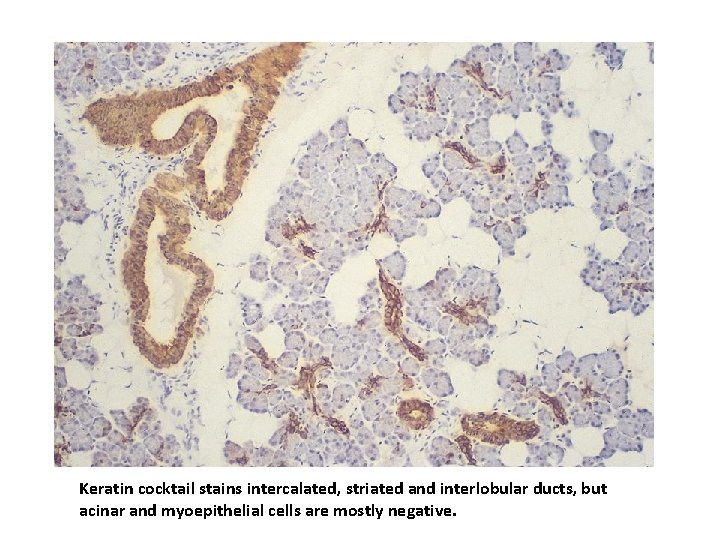 Keratin cocktail stains intercalated, striated and interlobular ducts, but acinar and myoepithelial cells are