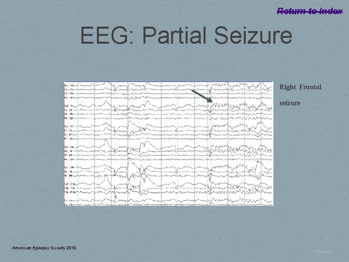 Return to index EEG: Partial Seizure Right Frontal seizure American Epilepsy Society 2010 C-Slide