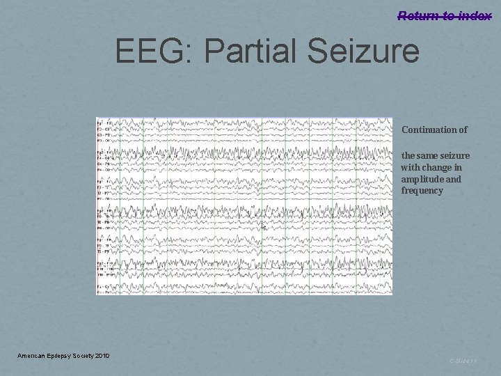 Return to index EEG: Partial Seizure Continuation of the same seizure with change in