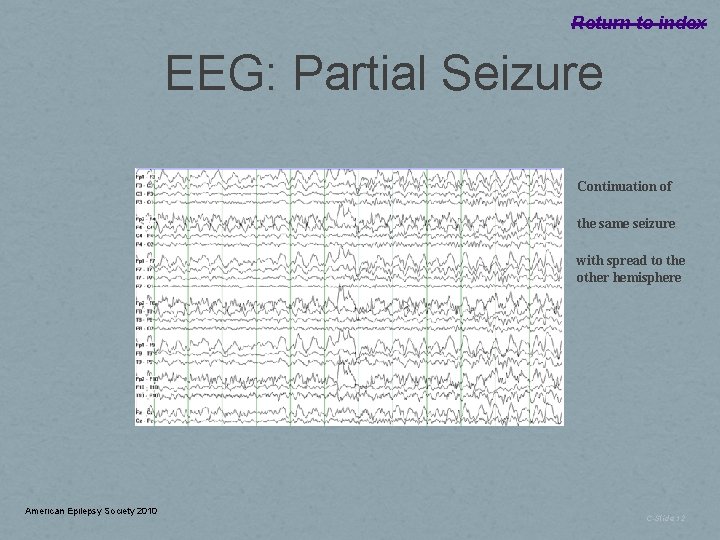 Return to index EEG: Partial Seizure Continuation of the same seizure with spread to