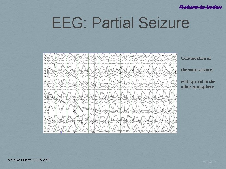 Return to index EEG: Partial Seizure Continuation of the same seizure with spread to