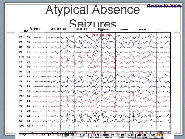 Atypical Absence Seizures American Epilepsy Society 2010 Return to index C-Slide 18 