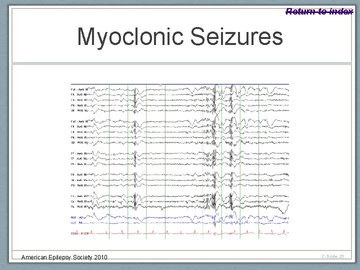 Return to index Myoclonic Seizures American Epilepsy Society 2010 C-Slide 20 