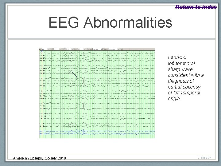 Return to index EEG Abnormalities Interictal left temporal sharp wave consistent with a diagnosis
