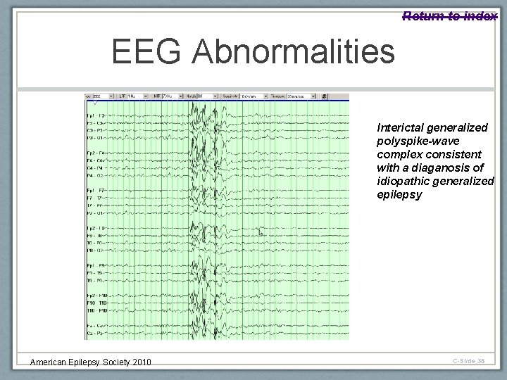 Return to index EEG Abnormalities Interictal generalized polyspike-wave complex consistent with a diaganosis of