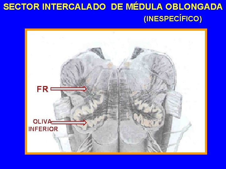 SECTOR INTERCALADO DE MÉDULA OBLONGADA (INESPECÍFICO) FR OLIVA INFERIOR 