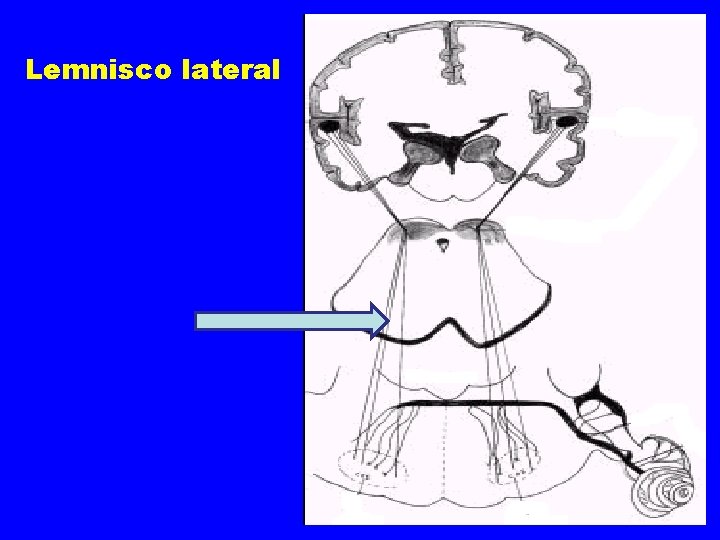 Lemnisco lateral 