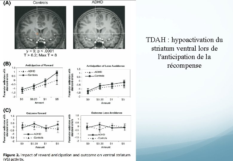 TDAH : hypoactivation du striatum ventral lors de l'anticipation de la récompense 
