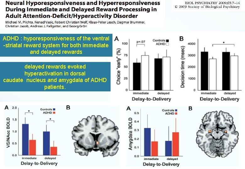 ADHD : hyporesponsiveness of the ventral -striatal reward system for both immediate and delayed