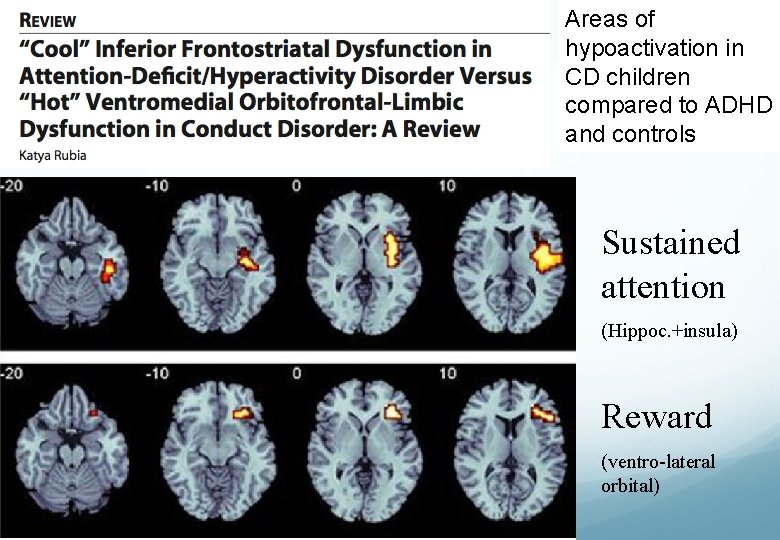 Areas of hypoactivation in CD children compared to ADHD and controls Sustained attention (Hippoc.