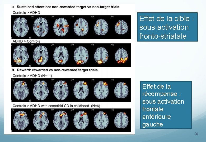 Effet de la cible : sous-activation fronto-striatale Effet de la récompense : sous activation