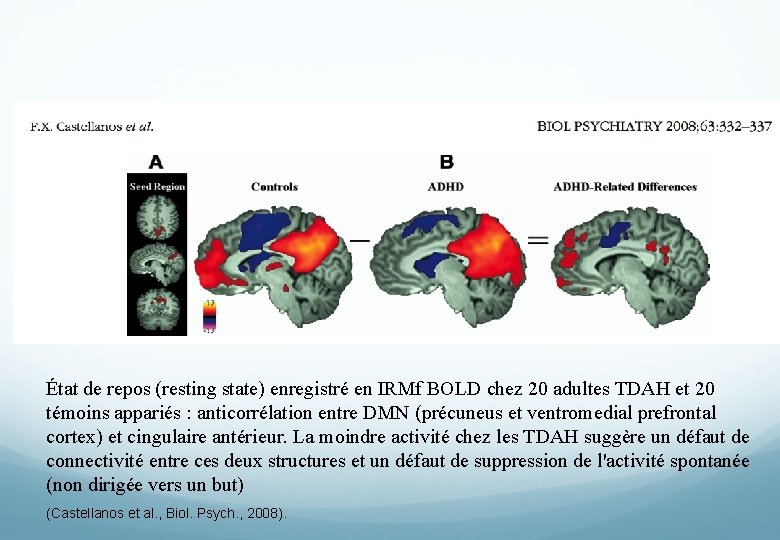 État de repos (resting state) enregistré en IRMf BOLD chez 20 adultes TDAH et