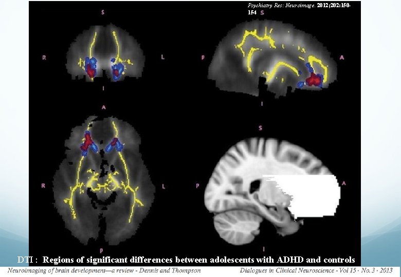 Psychiatry Res: Neuroimage. 2012; 202: 150154 DTI : Regions of significant differences between adolescents