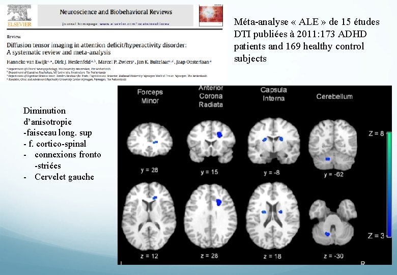 Méta-analyse « ALE » de 15 études DTI publiées à 2011: 173 ADHD patients