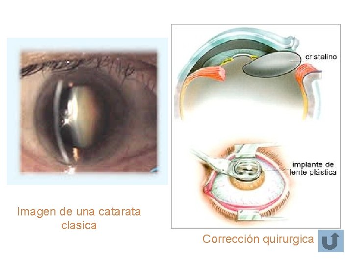 Imagen de una catarata clasica Corrección quirurgica Imagen de una catarata clasica Corrección quirurgica