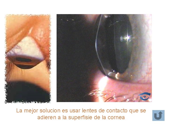 La mejor solucion es usar lentes de contacto que se adieren a la superfisie La mejor solucion es usar lentes de contacto que se adieren a la superfisie