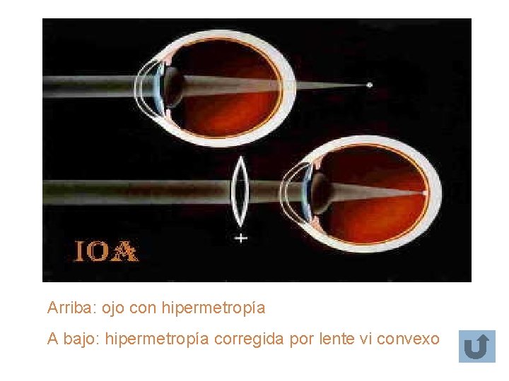 Arriba: ojo con hipermetropía A bajo: hipermetropía corregida por lente vi convexo Arriba: ojo con hipermetropía A bajo: hipermetropía corregida por lente vi convexo